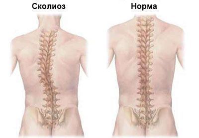 Сколиоз